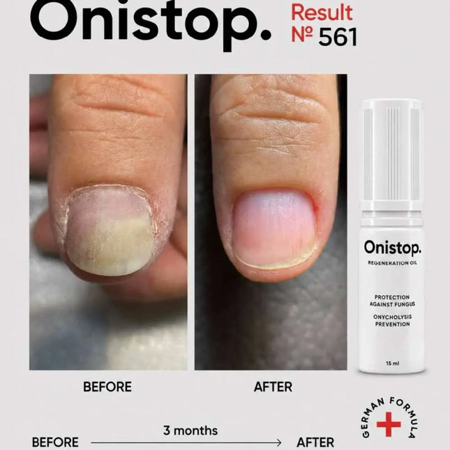 Regenerierendes Öl gegen Onycholyse - OniStop 15ml NAILSOFTHEDAY