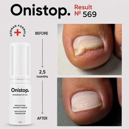 Regenerierendes Öl gegen Onycholyse - OniStop 15ml NAILSOFTHEDAY